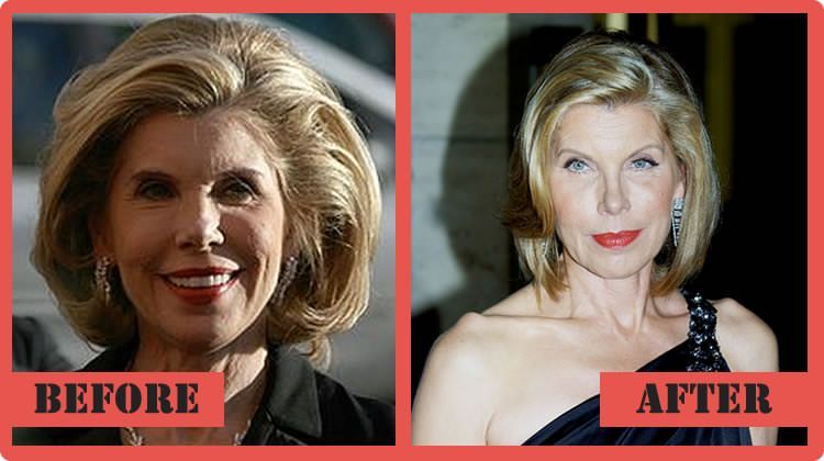 Christine Baranski lip fillers